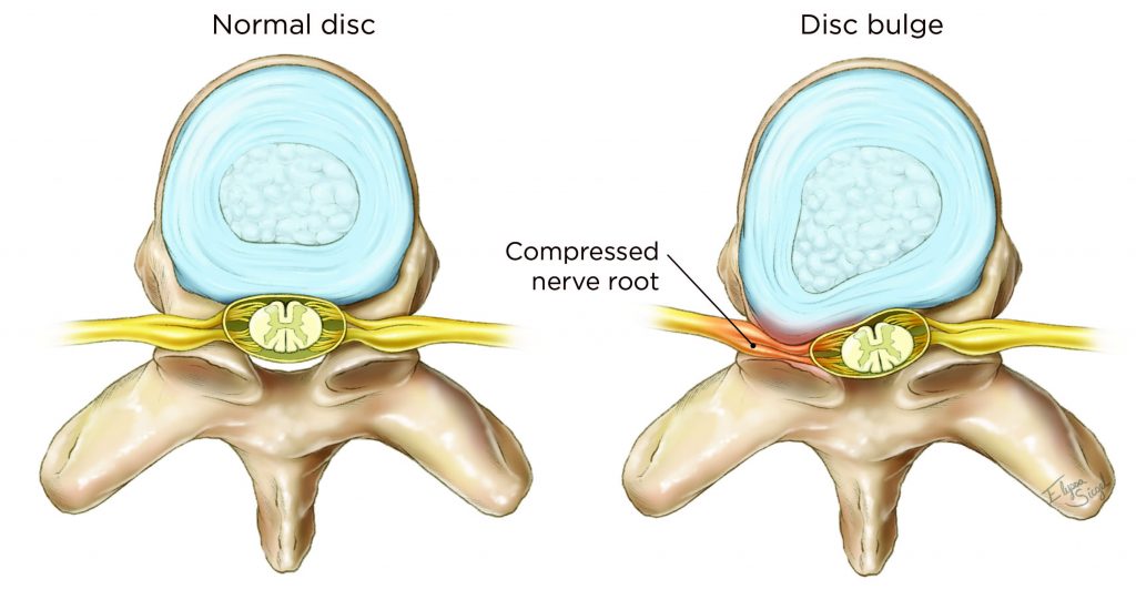 A Herniated Disc or a Bulging Disc: Is There a Difference, and How